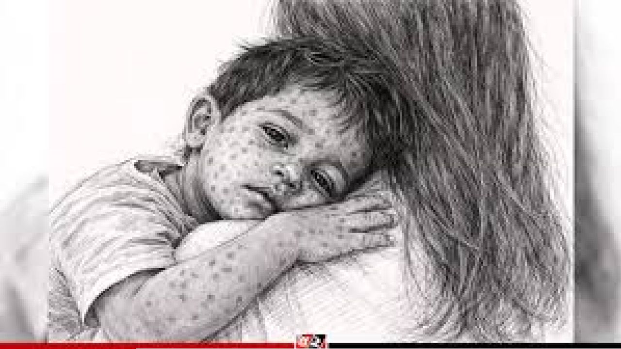বাংলাদেশে 'মহামারী'র আকার নিচ্ছে হাম: শতাধিক শিশুর মৃত্যুতে চরম উদ্বেগ, গণটিকাদানের ডাক
